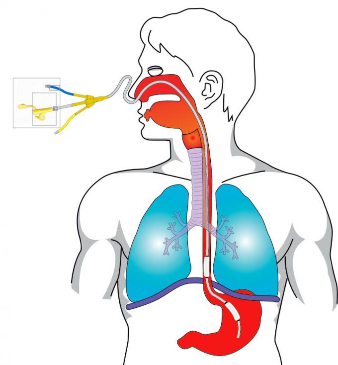 Kink resistent gepreformeerde orale endotracheale buis voor volwassenen 3